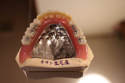 レビン歯加工義歯