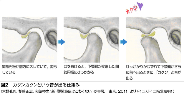 顎関節症図2