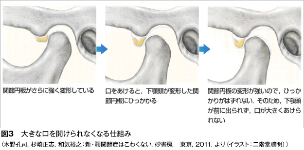 顎関節症図3