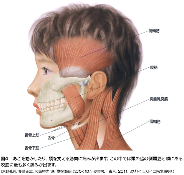 顎関節症図4
