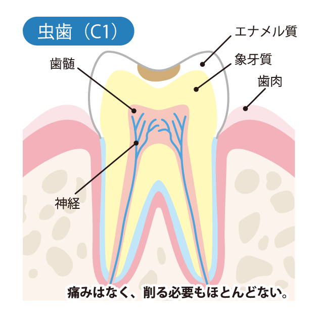 虫歯の進行度（C1）