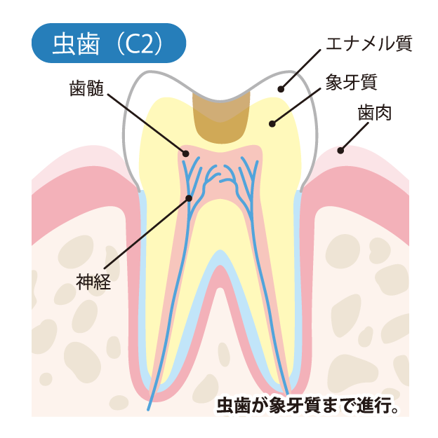 虫歯の進行度（C2）