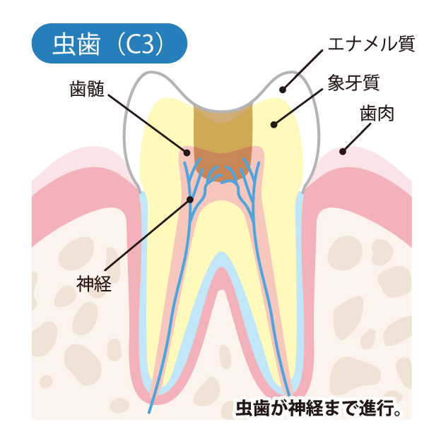 虫歯の進行度（C3）