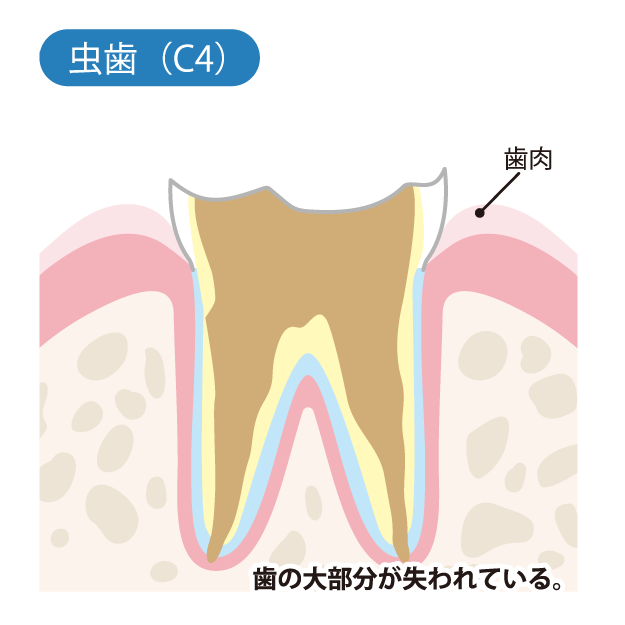 虫歯の進行度（C4）