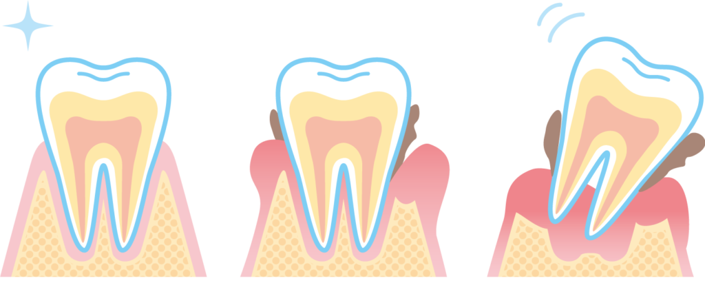 歯周病が進行していくメカニズム