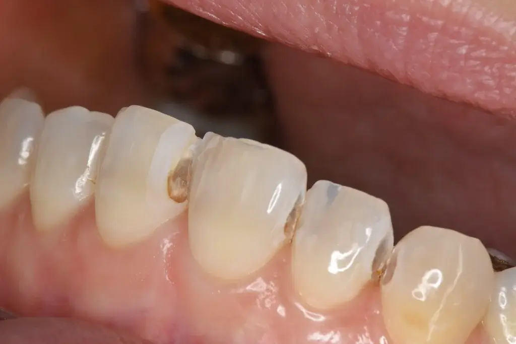 前歯部虫歯治療前
